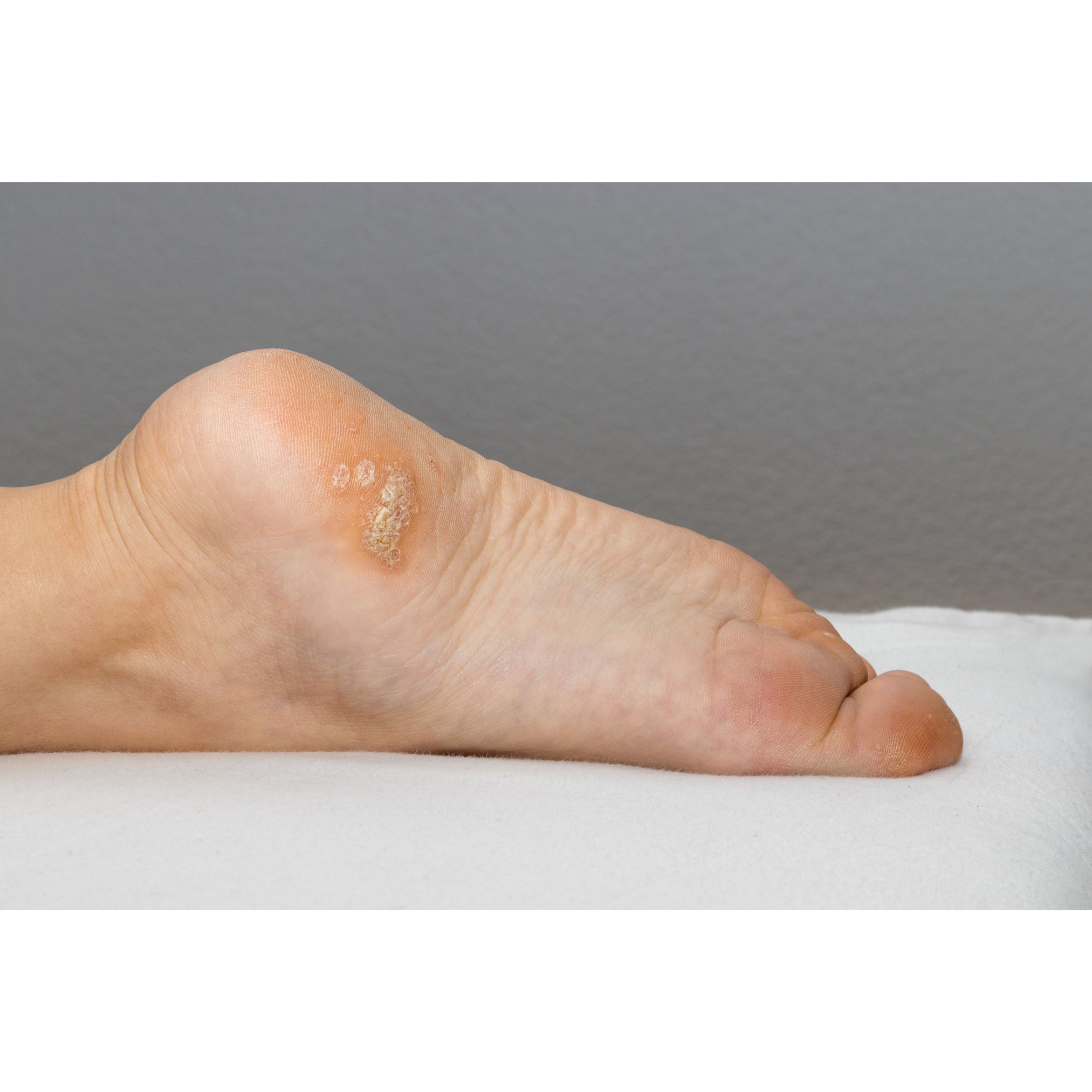 Skin condition of the foot