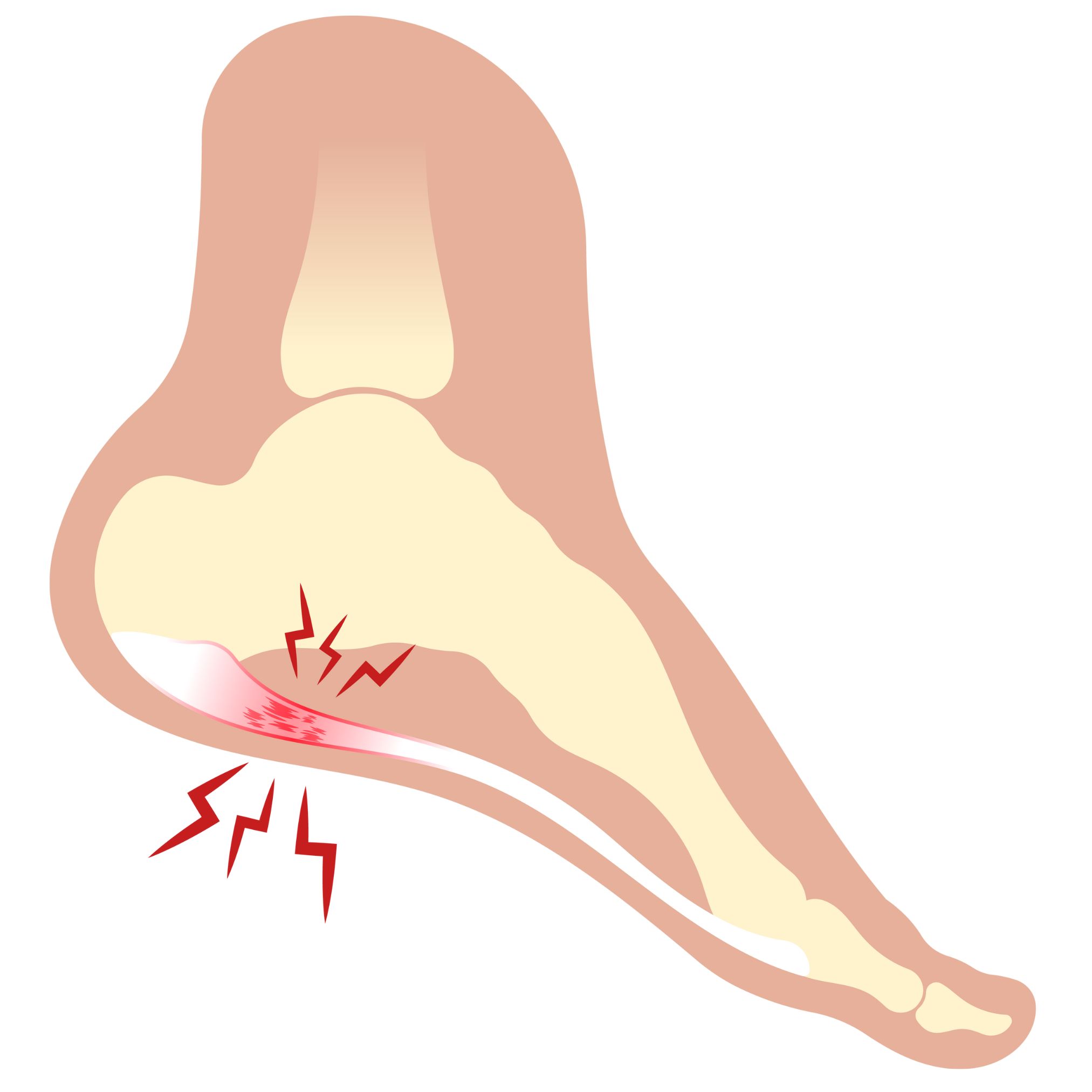 Plantar fasciitis heel pain